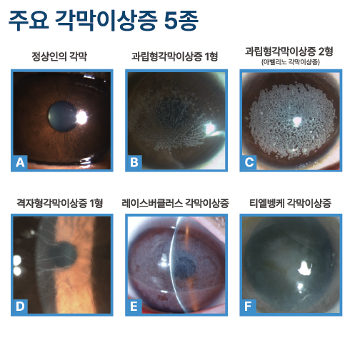 시력교정수술 전 꼭 알아야 할 아벨리노검사 (각막이상증 유전자 검사) - 아벨리노